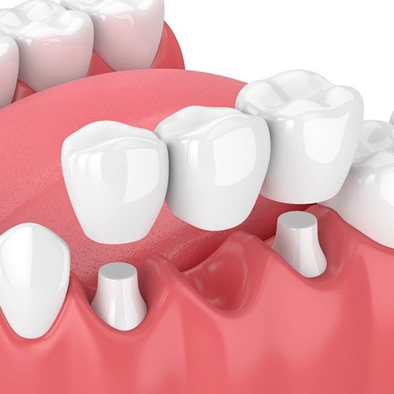 digital illustration of a dental bridge