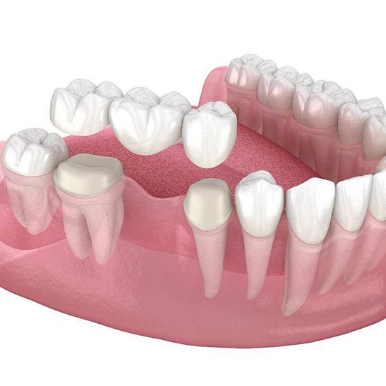 digital illustration of posterior dental bridge