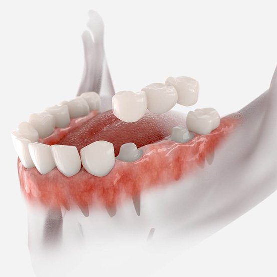 traditional dental bridge on lower jaw