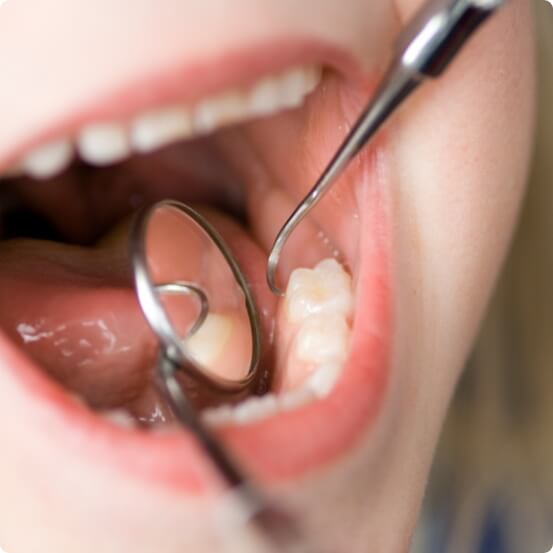 Dentist examining smile after tooth colored filling