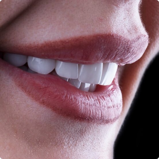 Closeup of flawless smile with veneers