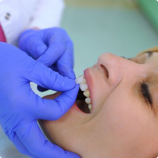 Dentist comparing dnetal patient's smile to cosmetic dental bonding shade option
