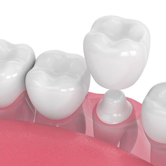 a digital illustration of a dental crown 