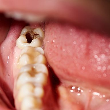 Picture of a severely decayed tooth