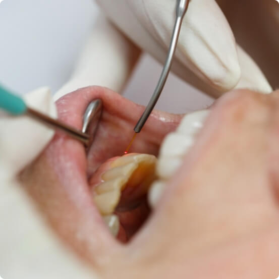 Closeup of smile during soft tissue laser dentistry treatment