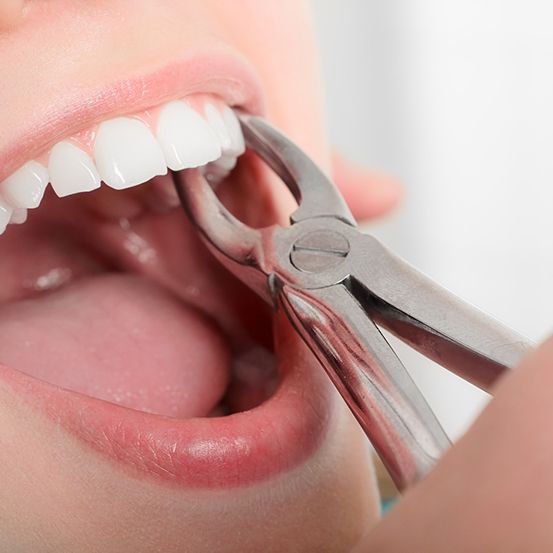 Tooth being grasped by forceps for extraction