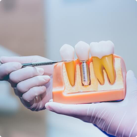 Dentist using model to explain tooth replacement with dental implants