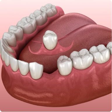 Animated smile during single tooth replacement