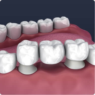 Animated smile during dental bridge placement