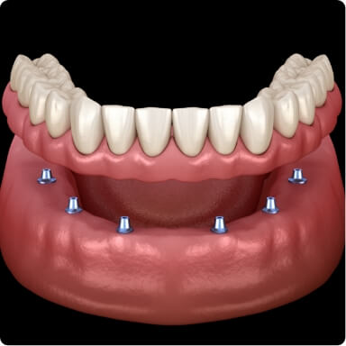 Animated smile during denture placement