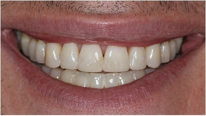 Closeup of beautiful smile after cosmetic dentistry
