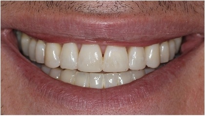 Perfected smile after cosmetic dentistry