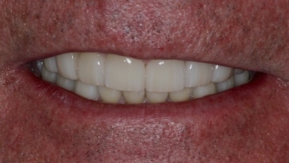 Closeup of smile after gap between front teeth is closed