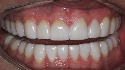 Closeup of repaired evenly spaced teeth after dental treatment