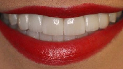 Closeup of smile with evenly sized healthy teeth