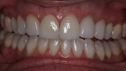 Closeup of smile after dental treatment