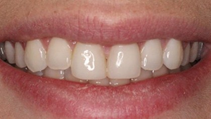 Closeup of flawless healthy smile after cosmetic dentistry