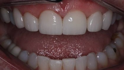 Bright healthy smile after cosmetic dentistry