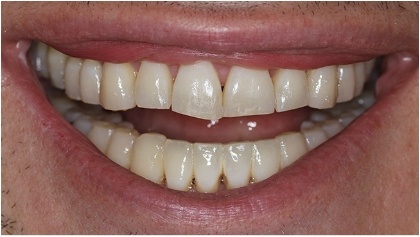 Smile with damage and discoloration before cosmetic dentistry