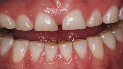 Closeup of worn unevenly spaced teeth before dental treatment