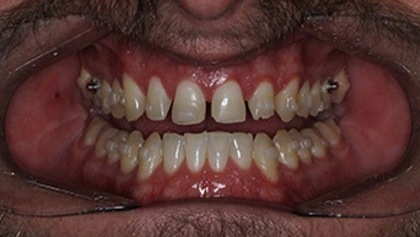 Closeup of severely damaged and decayed teeth before dental restoration