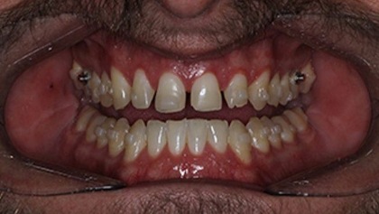 Smile with extensive tooth decay and damage before dental restoration