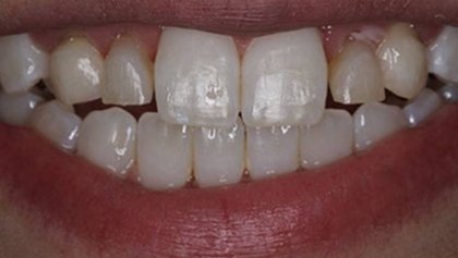 Closeup of smile with teeth of different sizes