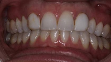 Closeup of smile before dental treatment