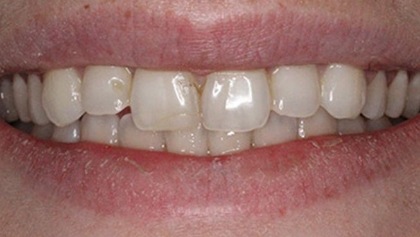 Closeup of smile with several minor imperfections before cosmetic dentistry