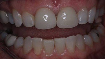 Smile with discolored teeth and excess gum tissue before cosmetic dentistry