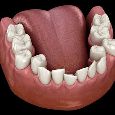 Illustration of crowded teeth