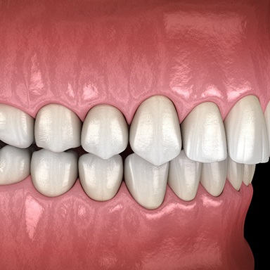 Illustration of an overbite