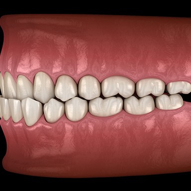 Illustration of an underbite