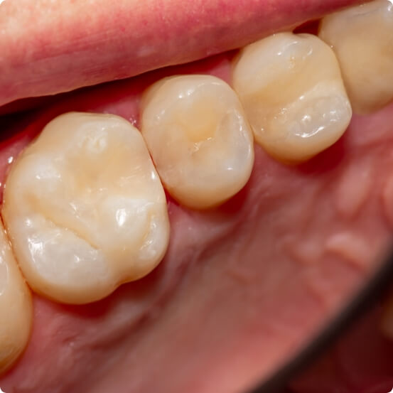 Closeup of smile after tooth colored filling treatment