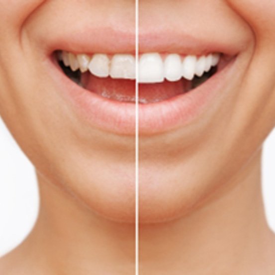 Before and after comparison of woman with veneers