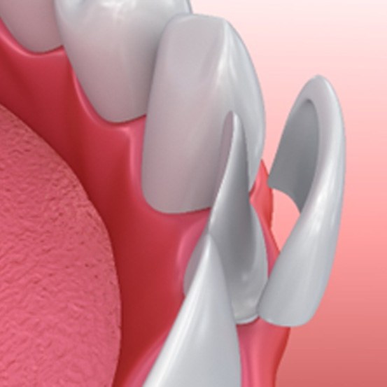 Illustration of veneer being placed on tooth
