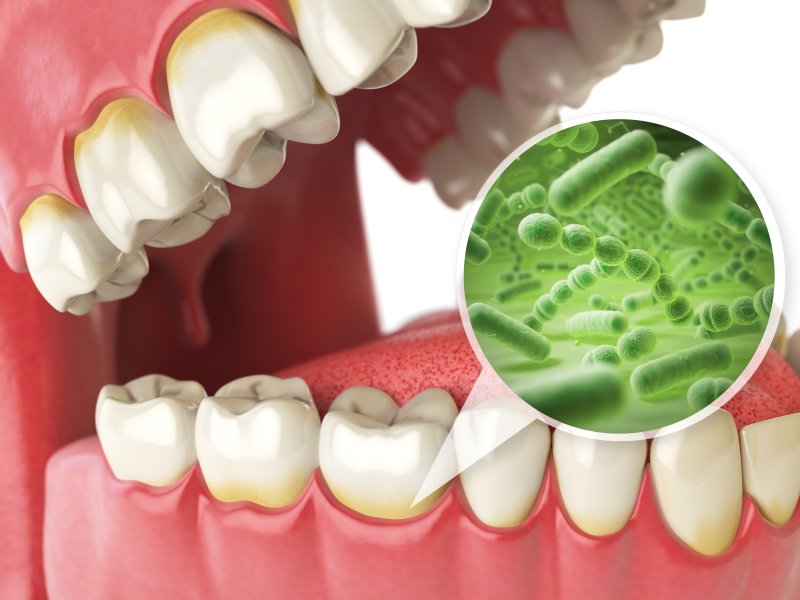 diagram of bacteria along the gum line