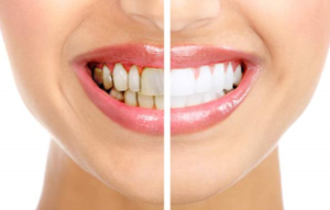 a comparison of stained and whitened teeth